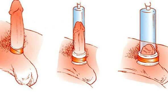 Princip fungování vakuové pumpy, která dokáže zvětšit penis